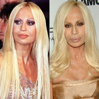Donatella Versace: Vorher-Nachher