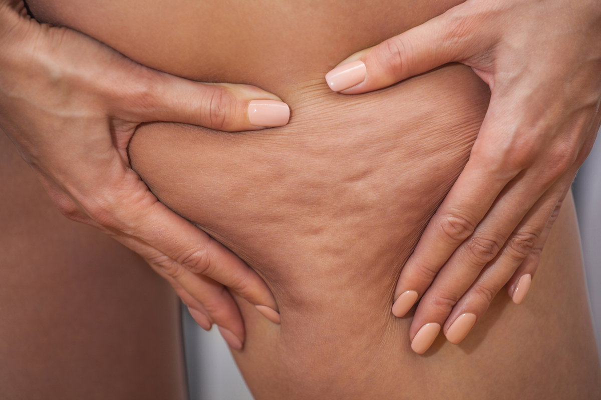 Körperliche Veränderungen in der Schwangerschaft: Entstehende oder verstärkte Cellulite