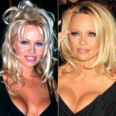 Pamela Anderson operiert?