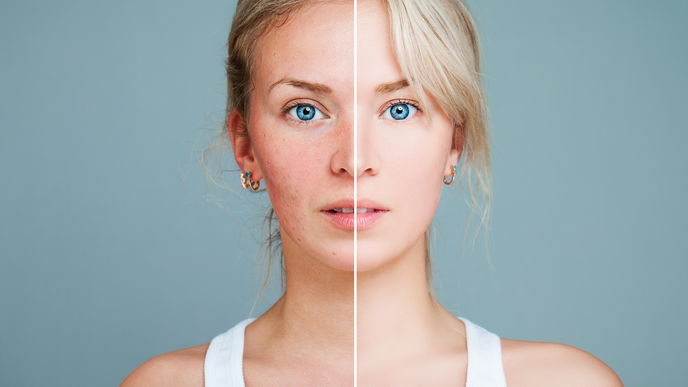 Rosacea: Das sind die besten Cremes – laut Dermatologin