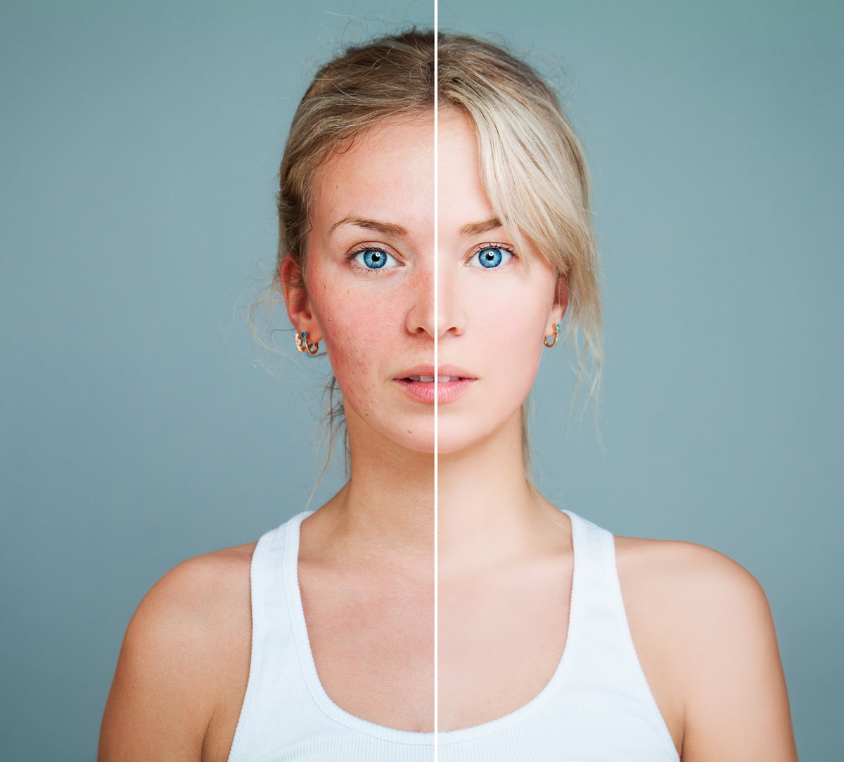 Junge Frau mit Rosacea und gesunder Haut, das Bild ist in der Mitte geteilt
