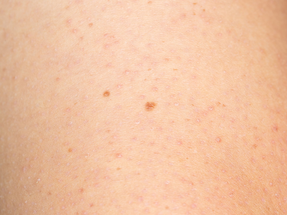 Reibeisenhaut (Keratosis Pilaris)