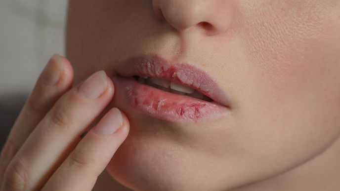 Brennende Lippen: Diese Tipps helfen wirklich