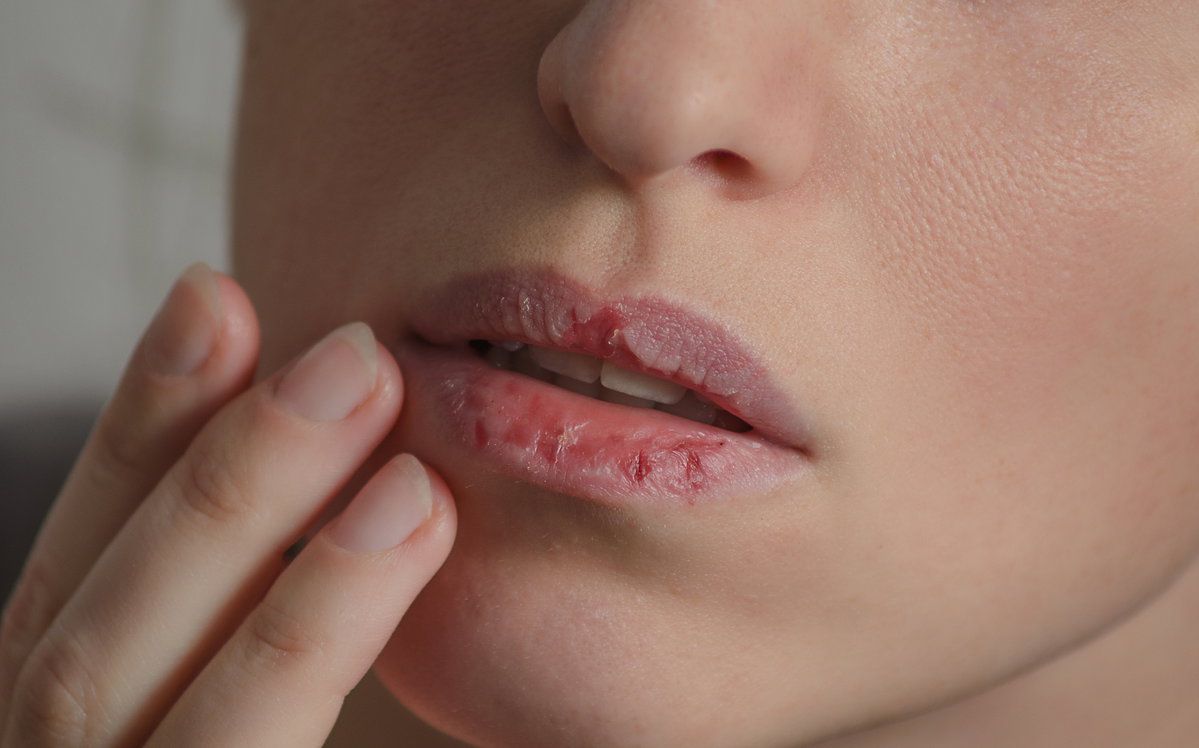 Brennende Lippen