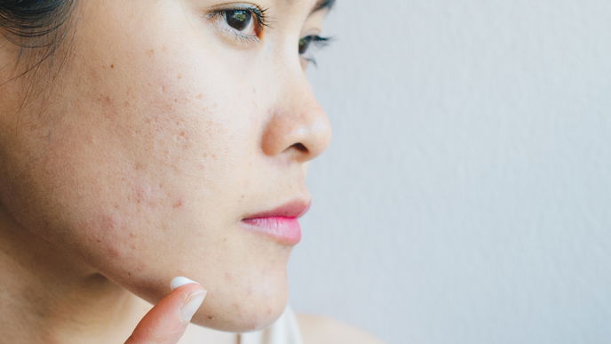 Zink gegen Akne: Anwendung und wirksame Tipps