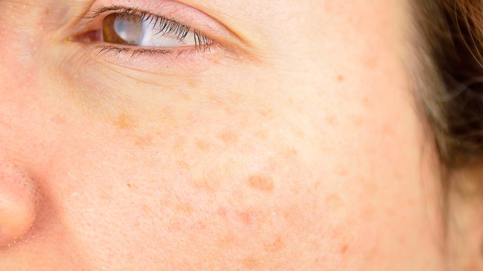 Altersflecken: Ursachen und richtige Behandlung der Haut