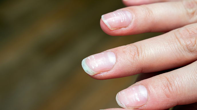 Weiße Flecken auf Fingernägel: Woher kommen sie und was hilft?