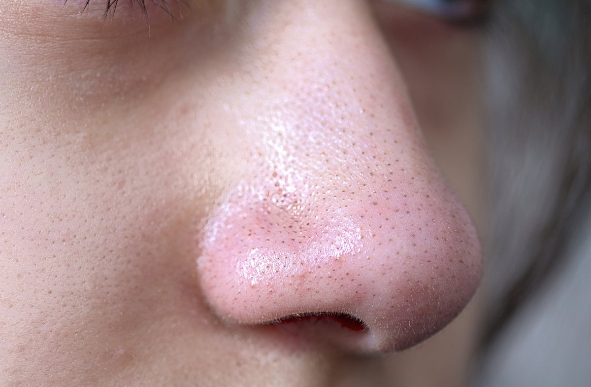 Mitesser und Blackheads entfernen