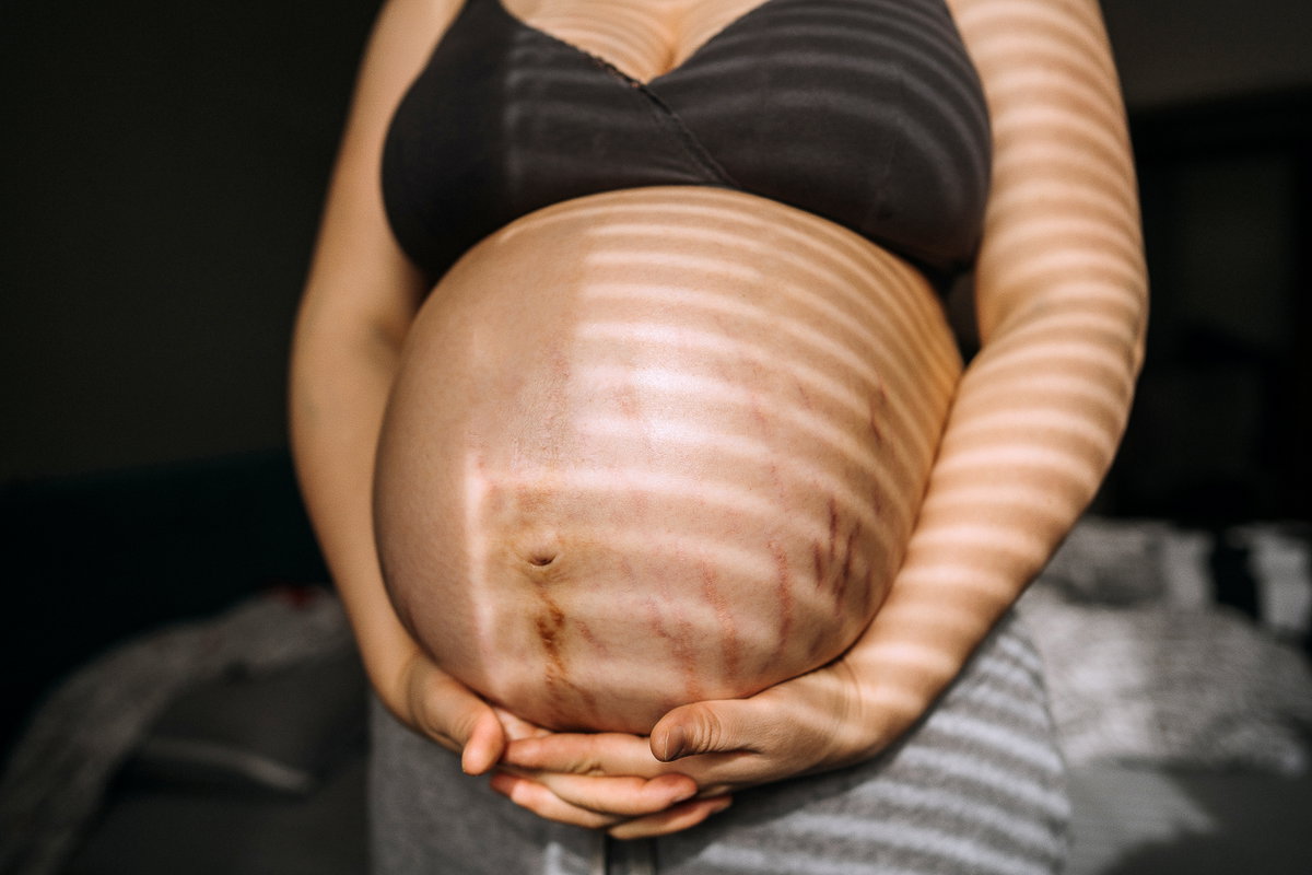Schwangerschaftsstreifen Bauch