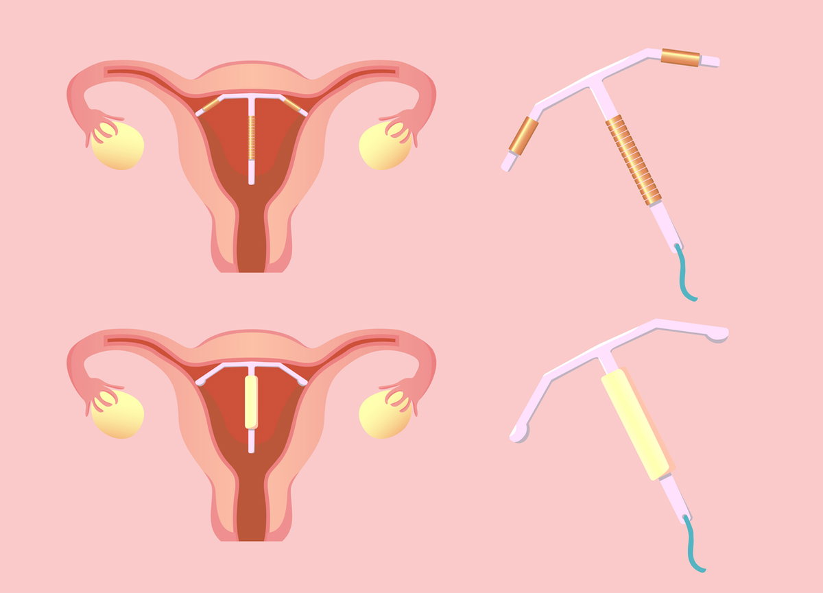 Hormonspirale vs. Kupferspirale