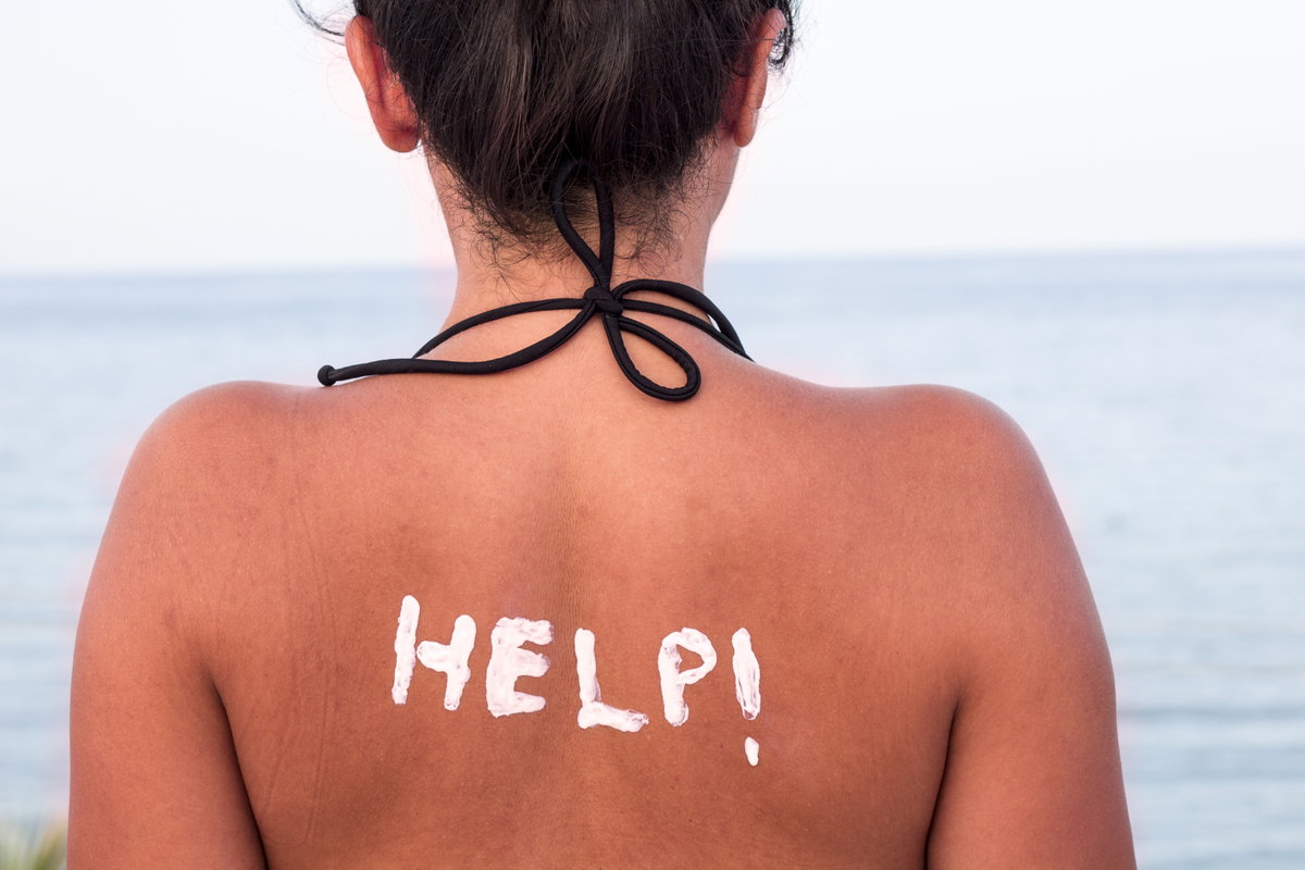 Frau mit Sonnenbrand