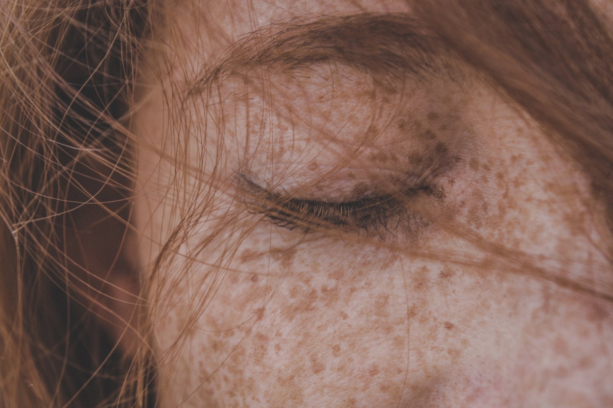 Sommersprossen im Gesicht