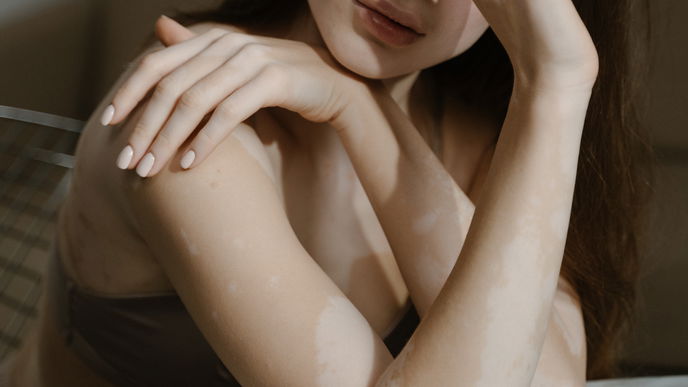 Helle Flecken auf der Haut: Alles, was du über Vitiligo wissen musst