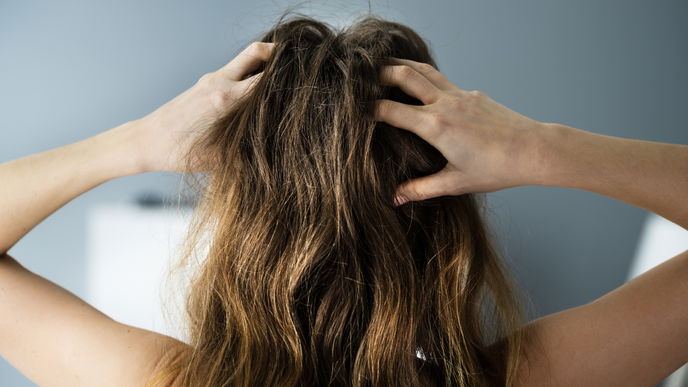 Schuppige Kopfhaut: Das hilft gegen die lästigen Schuppen