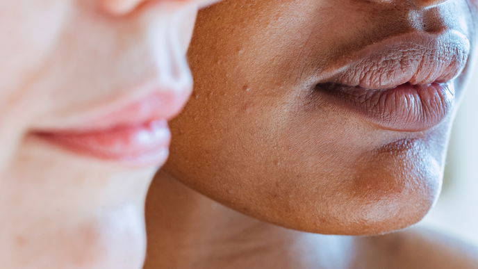 Sebaceous Filaments: Was ist das eigentlich und was hilft dagegen?