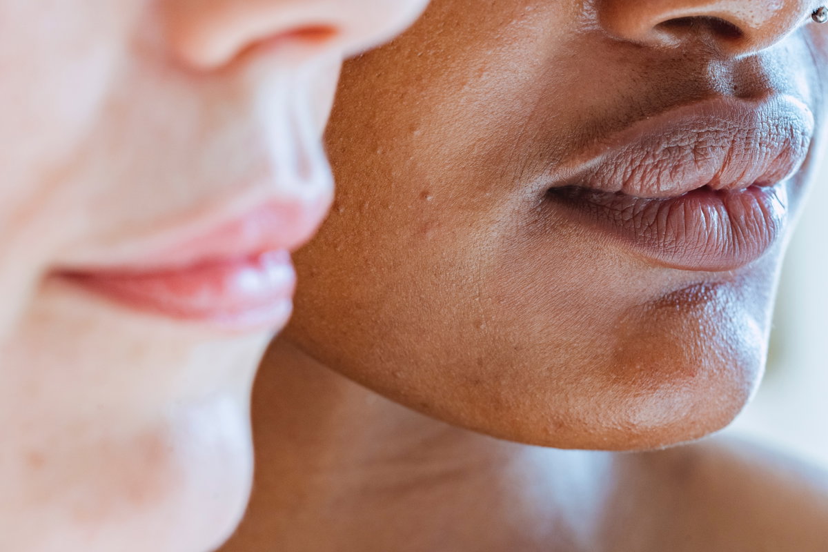 Frauen mit Sebaceous Filaments