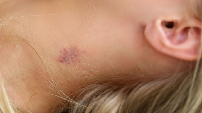 Knutschfleck entfernen: Diese 3 SOS-Tipps helfen wirklich