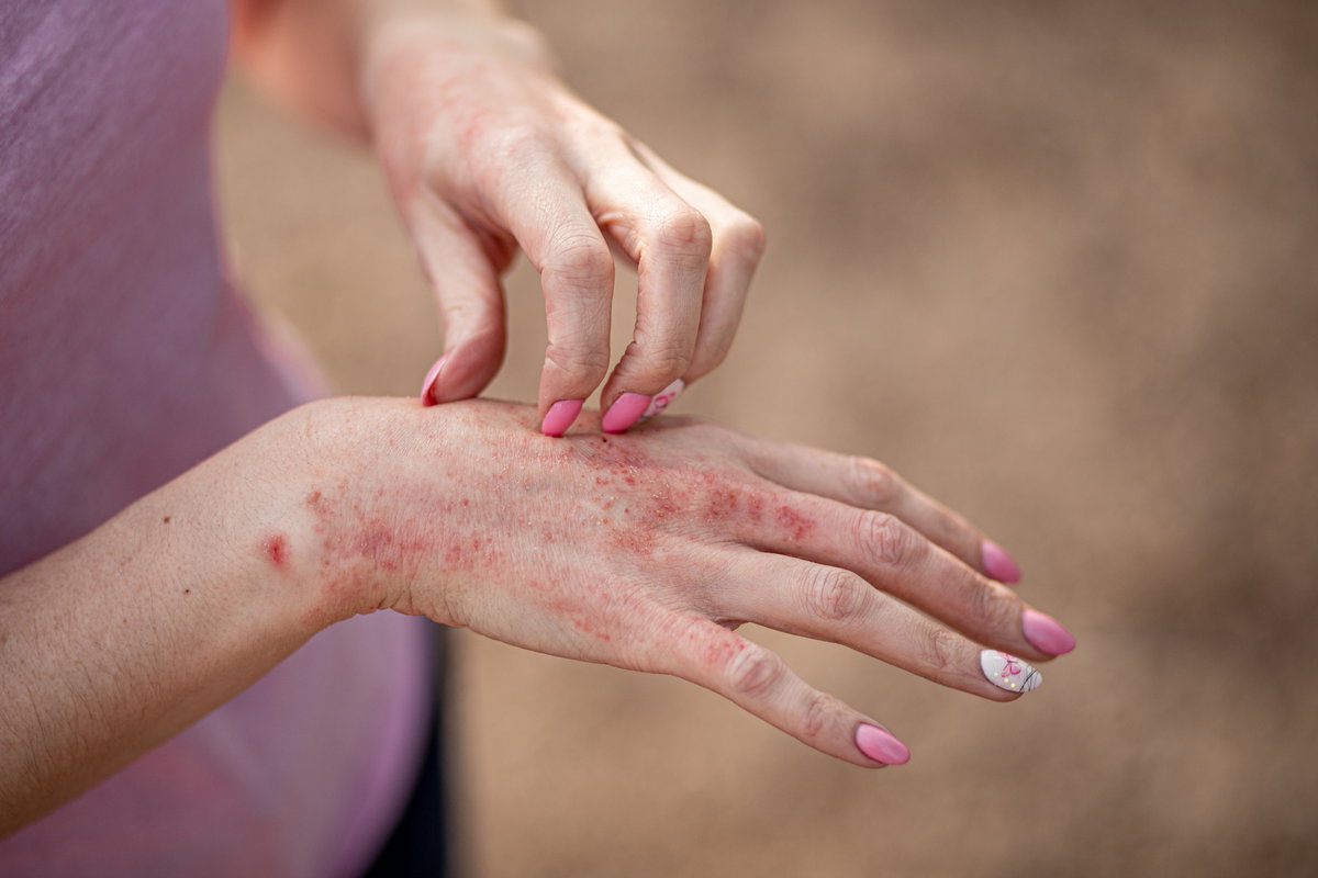 Rotes Ekzem auf Hand