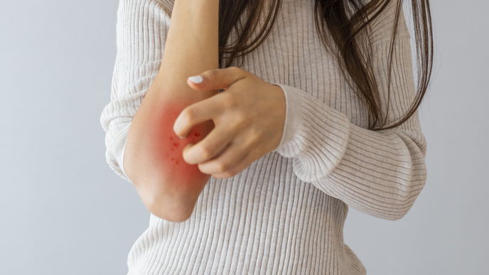Schuppenflechte: Diese Dinge helfen wirklich gegen die Hauterkrankung Psoriasis