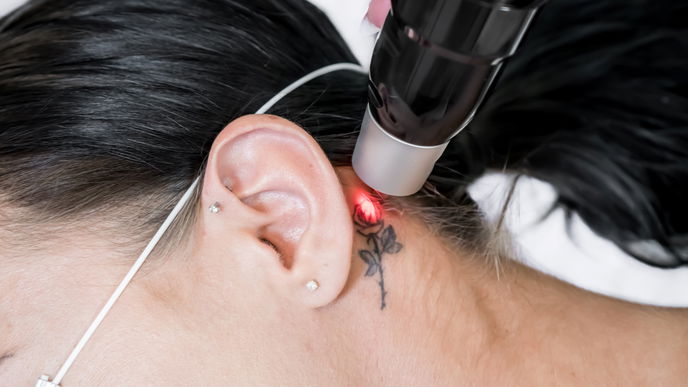 Tattooentfernung: So verabschiedest du dich für immer von deinem Tattoo