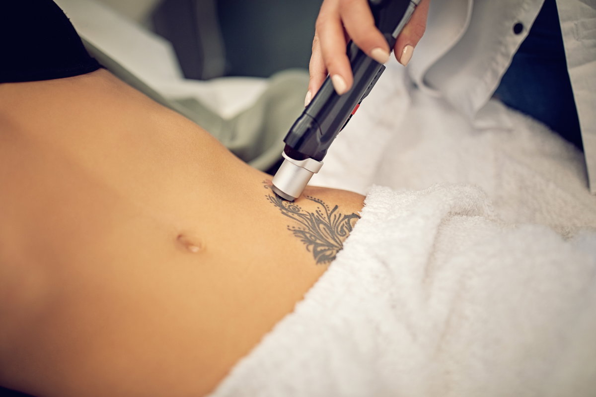 Tattoo am Bauch wird gelasert