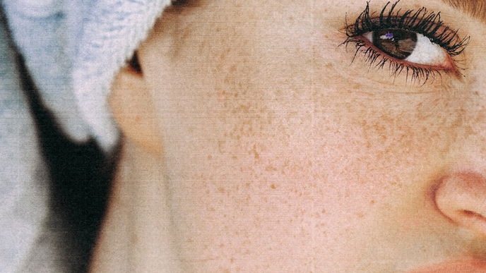 Melasma: So entstehen die Hautflecken und das kannst du gegen die Hyperpigmentierung tun 
