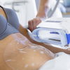 CoolSculpting: So verlierst du Fettpölsterchen durch Kälte