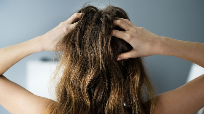 Schuppige Kopfhaut? Dann machst du vielleicht diese 3 typischen Fehler