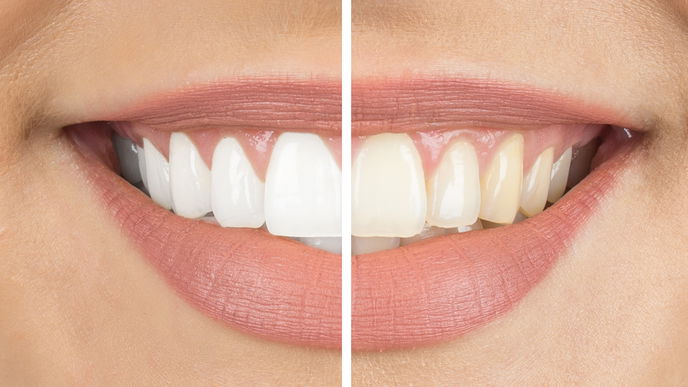 Bleaching: Das solltest du über die professionelle Zahnaufhellung wissen