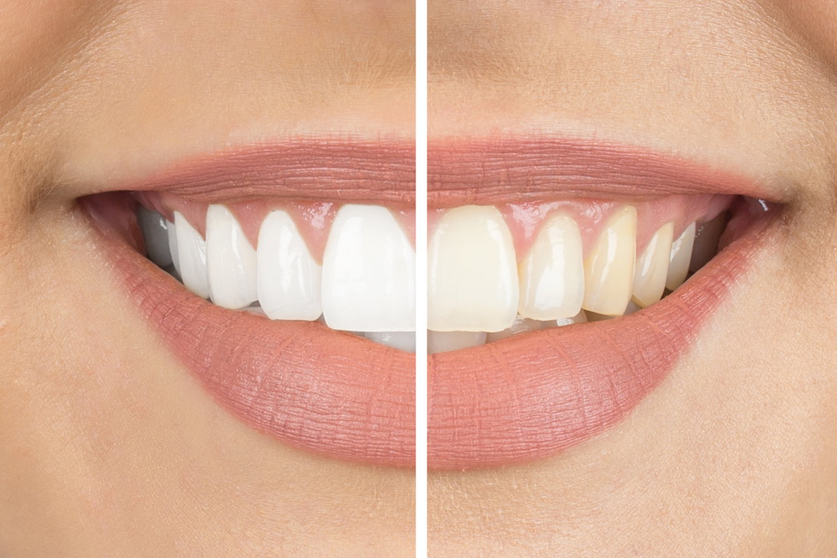 Bleaching: Vergleich vorher nachher