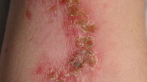Was ist eigentlich Impetigo contagiosa?