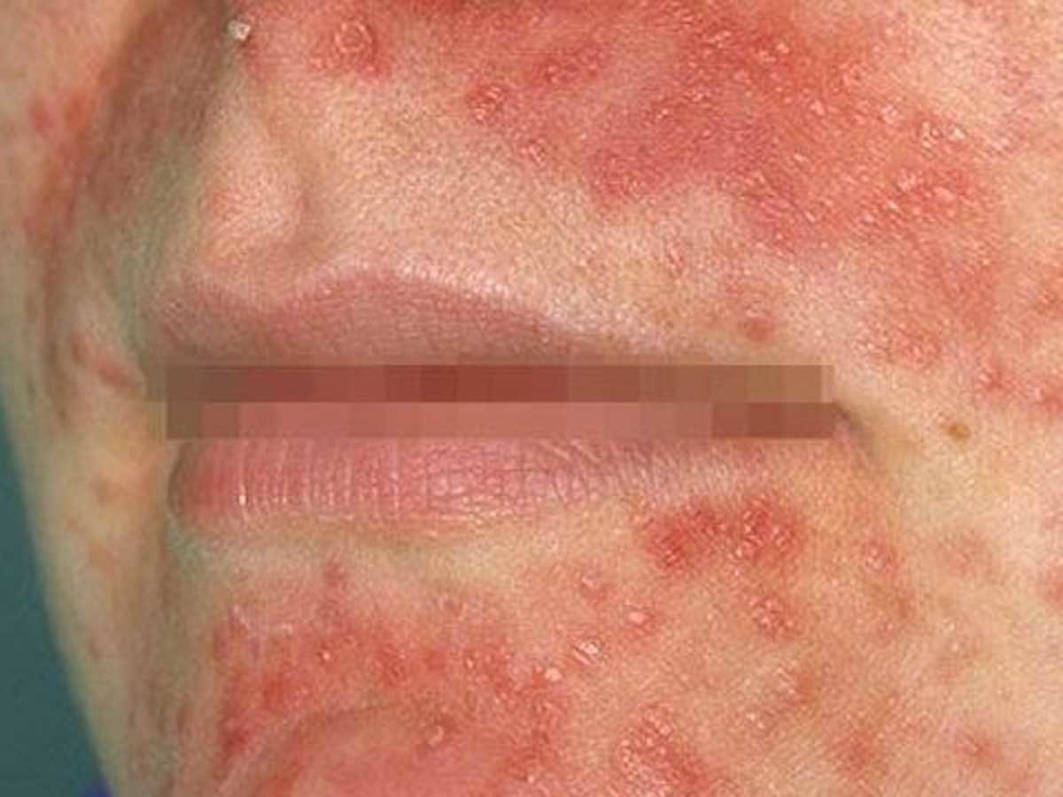 periorale-dermatitis