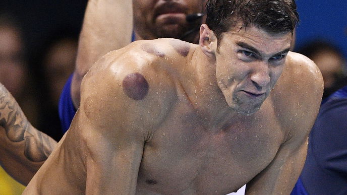 Schröpfen: Daher kommen Michael Phelps' Flecken am Rücken