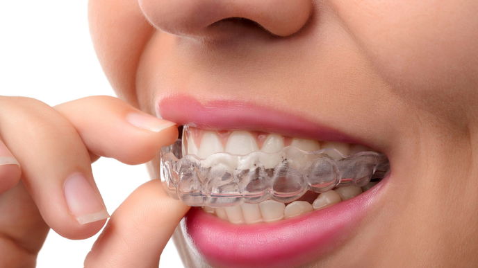 Invisalign - Die unsichtbare Zahnspange