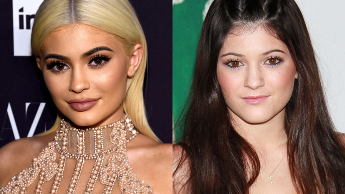 Kylie Jenner: Das ist der wahre Grund für ihre Lippenvergrößerung