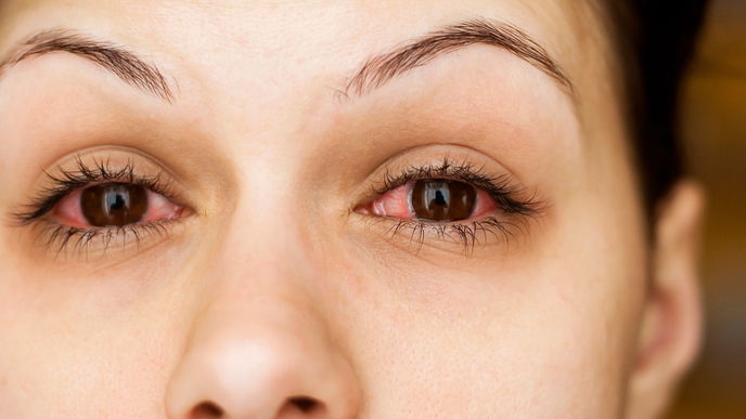Augengrippe: Symptome, Ursache und Dauer