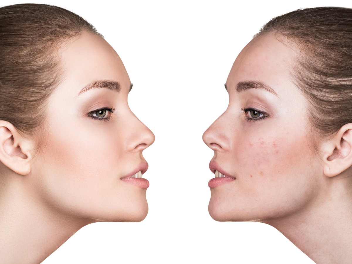 periorale-dermatitis