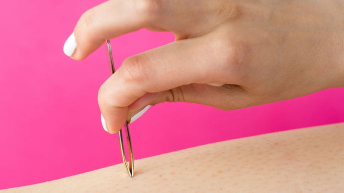 Eingewachsene Haare zu zupfen ist der neue Trend auf Instagram
