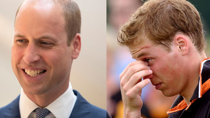 Prinz William hat eine Harry Potter-Narbe und das steckt dahinter